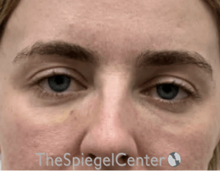 Tear Trough / Under Eye Fillers Before & After Gallery - Patient 291052 - Image 2