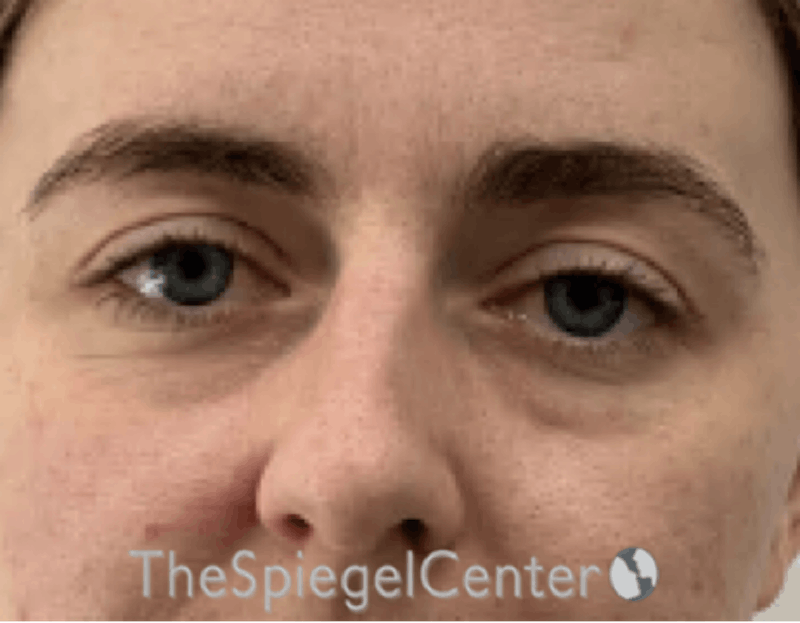 Tear Trough / Under Eye Fillers Before & After Gallery - Patient 291052 - Image 1