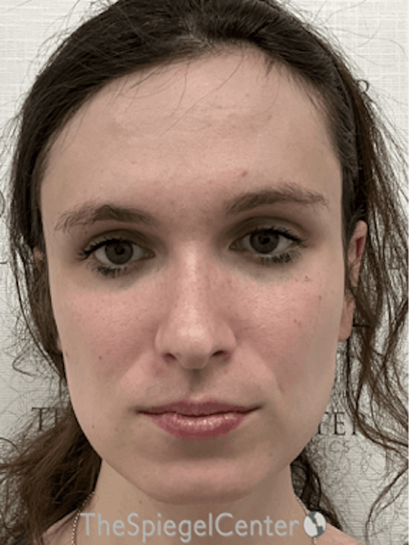 FFS Before & After Gallery - Patient 374792 - Image 3