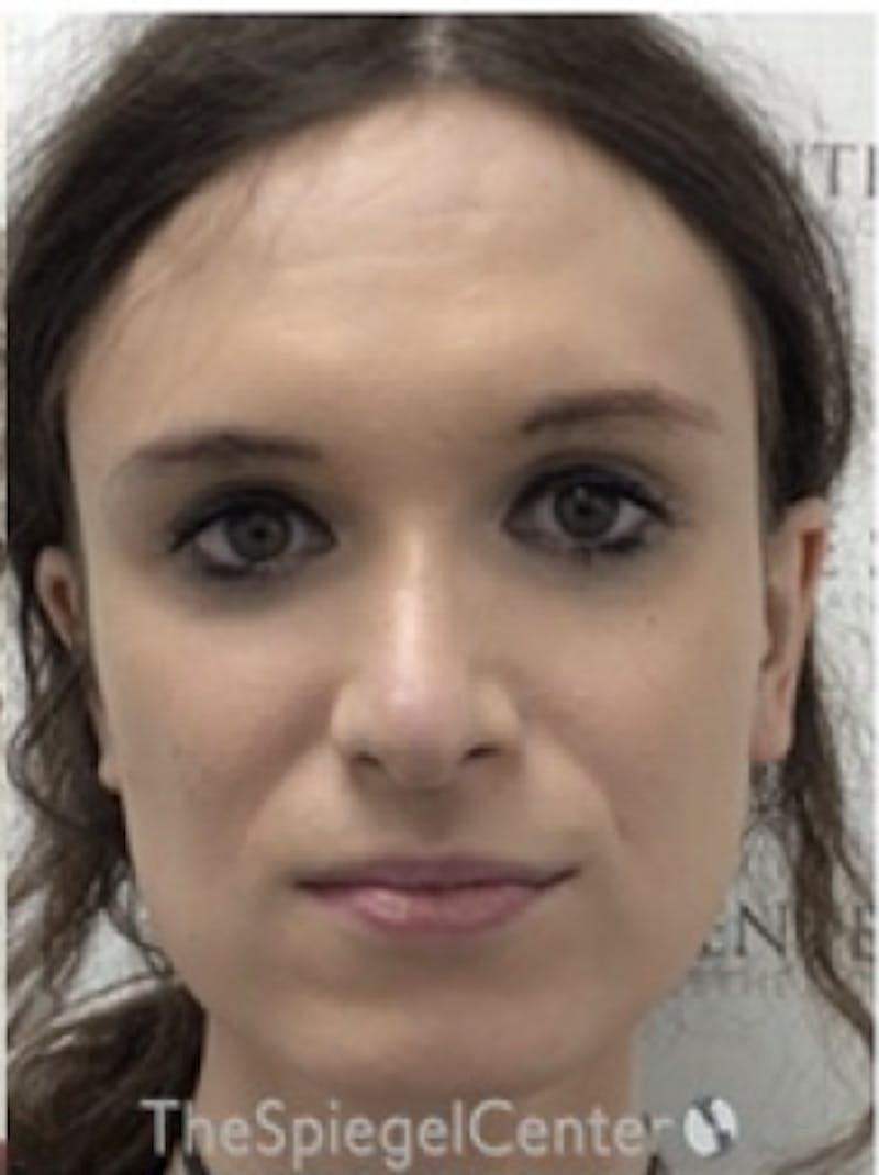 FFS Before & After Gallery - Patient 374792 - Image 2
