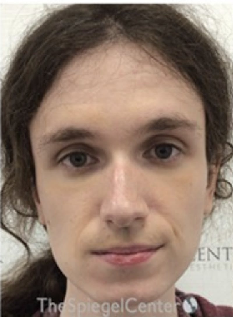 FFS Before & After Gallery - Patient 374792 - Image 1