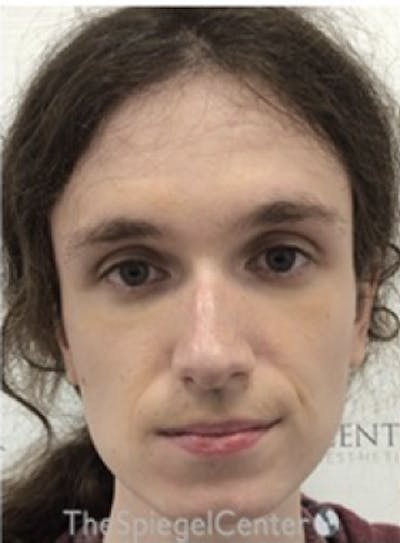 FFS Before & After Gallery - Patient 374792 - Image 1