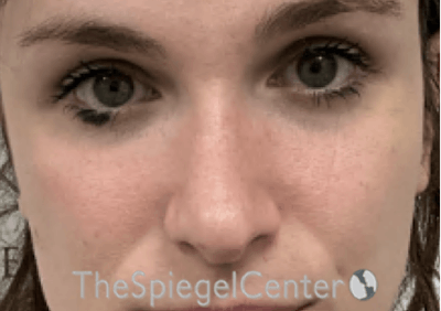 Rhinoplasty Before & After Gallery - Patient 176041 - Image 4