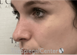 Rhinoplasty Before & After Gallery - Patient 176041 - Image 2