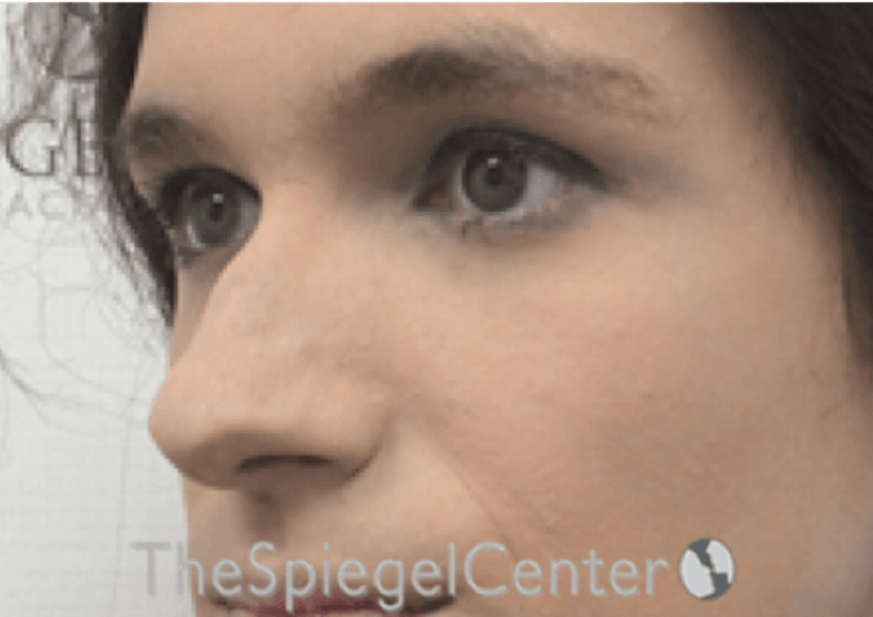 Rhinoplasty Before & After Gallery - Patient 176041 - Image 1