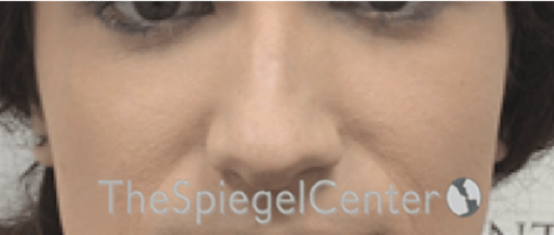 Cheek Implants Before & After Gallery - Patient 385064 - Image 3