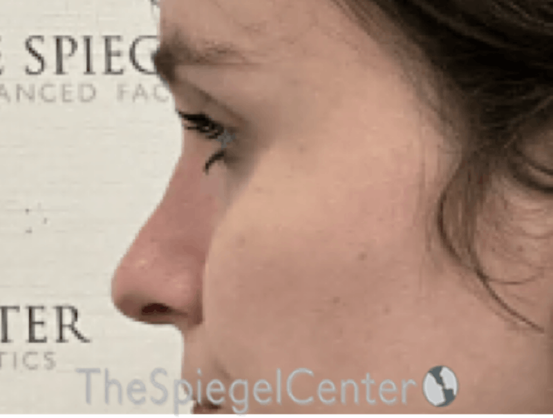 Cheek Implants Before & After Gallery - Patient 385064 - Image 2