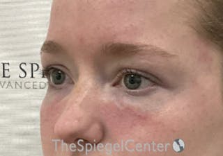 Tear Trough / Under Eye Fillers Before & After Gallery - Patient 542671 - Image 4