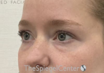 Tear Trough / Under Eye Fillers Before & After Gallery - Patient 542671 - Image 3