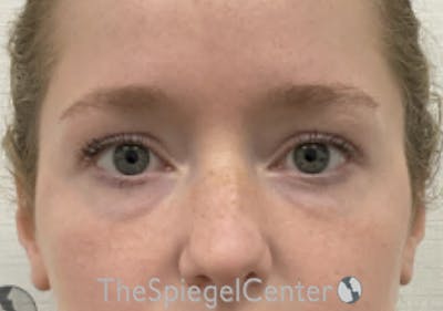 Temple Filler Before & After Gallery - Patient 517626 - Image 1