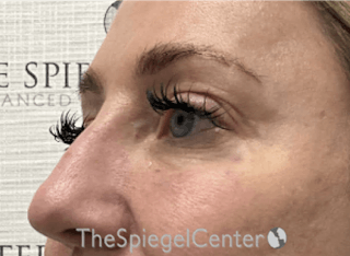 Tear Trough / Under Eye Fillers Before & After Gallery - Patient 147822 - Image 4