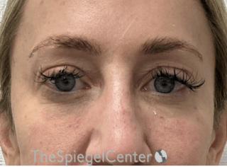 Tear Trough / Under Eye Fillers Before & After Gallery - Patient 147822 - Image 2