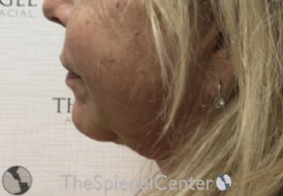 Chin Augmentation Before & After Gallery - Patient 386949 - Image 4