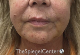 Chin Augmentation Before & After Gallery - Patient 386949 - Image 2