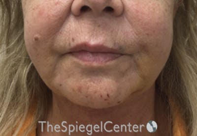 Chin Augmentation Before & After Gallery - Patient 386949 - Image 2