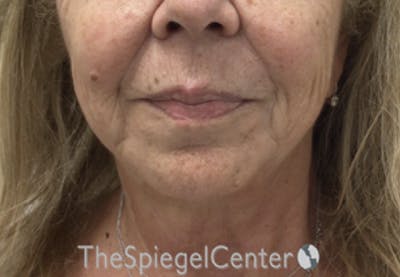 Chin Augmentation Before & After Gallery - Patient 386949 - Image 1
