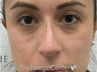 Non-Surgical Rhinoplasty / Nose Filler Before & After Gallery - Patient 278907 - Image 2