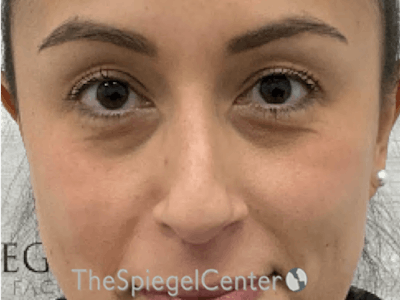 Non-Surgical Rhinoplasty / Nose Filler Before & After Gallery - Patient 278907 - Image 1
