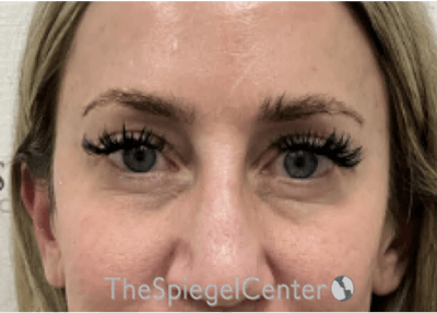 Temple Filler Before & After Gallery - Patient 168094 - Image 2
