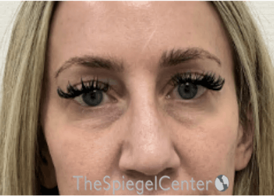 Temple Filler Before & After Gallery - Patient 168094 - Image 1