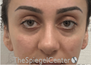 Revision Rhinoplasty Before & After Gallery - Patient 201886 - Image 4