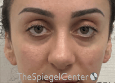Revision Rhinoplasty Before & After Gallery - Patient 201886 - Image 4