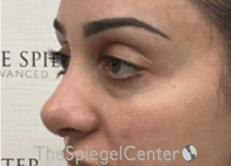Revision Rhinoplasty Before & After Gallery - Patient 201886 - Image 2