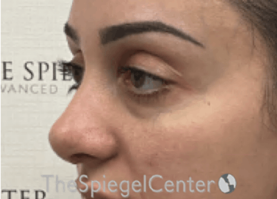 Revision Rhinoplasty Before & After Gallery - Patient 201886 - Image 2