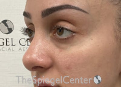 Revision Rhinoplasty Before & After Gallery - Patient 201886 - Image 1