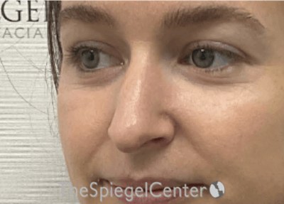 Non-Surgical Rhinoplasty / Nose Filler Before & After Gallery - Patient 219307 - Image 3