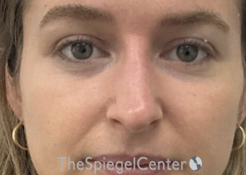 Non-Surgical Rhinoplasty / Nose Filler Before & After Gallery - Patient 219307 - Image 2
