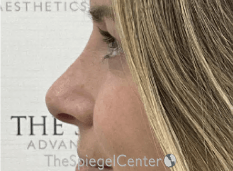 Non-Surgical Rhinoplasty / Nose Filler Before & After Gallery - Patient 388169 - Image 3