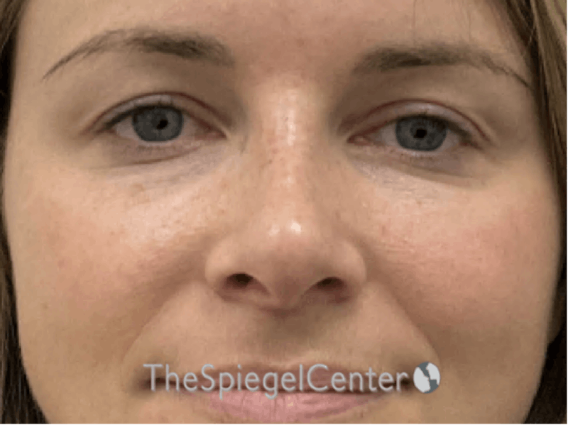 Non-Surgical Rhinoplasty / Nose Filler Before & After Gallery - Patient 388169 - Image 2