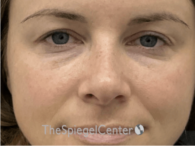 Non-Surgical Rhinoplasty / Nose Filler Before & After Gallery - Patient 388169 - Image 1