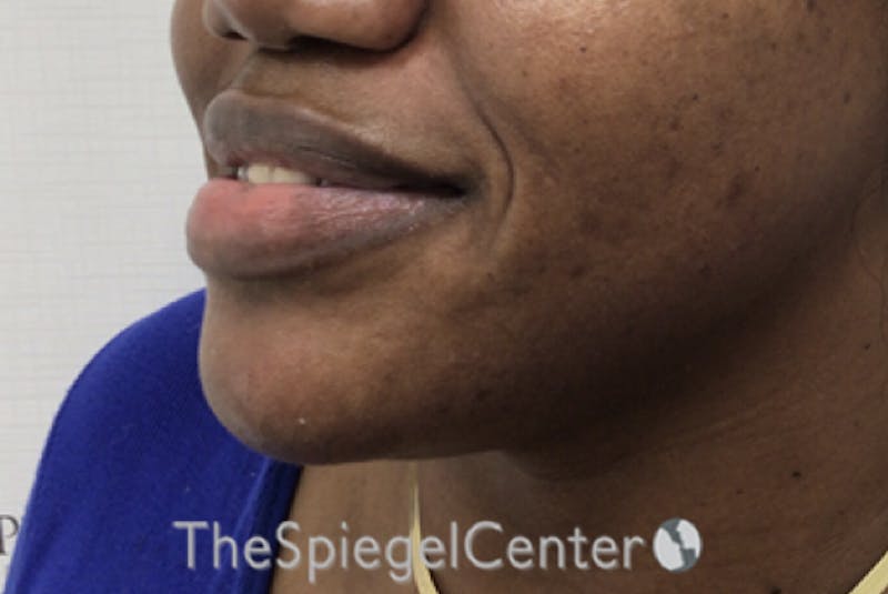 Chin Filler Before & After Gallery - Patient 256398 - Image 4