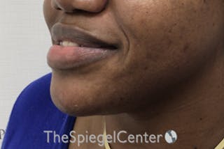 Chin Filler Before & After Gallery - Patient 256398 - Image 4