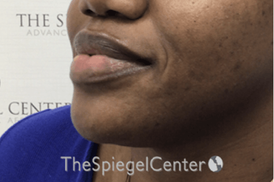 Chin Filler Before & After Gallery - Patient 256398 - Image 3