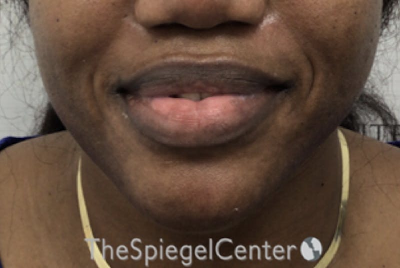 Chin Filler Before & After Gallery - Patient 256398 - Image 2