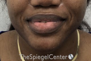 Chin Filler Before & After Gallery - Patient 256398 - Image 2
