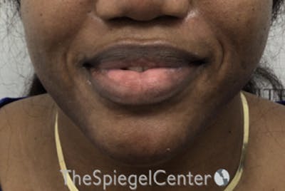 Chin Filler Before & After Gallery - Patient 256398 - Image 2