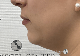 Chin Filler Before & After Gallery - Patient 326972 - Image 4