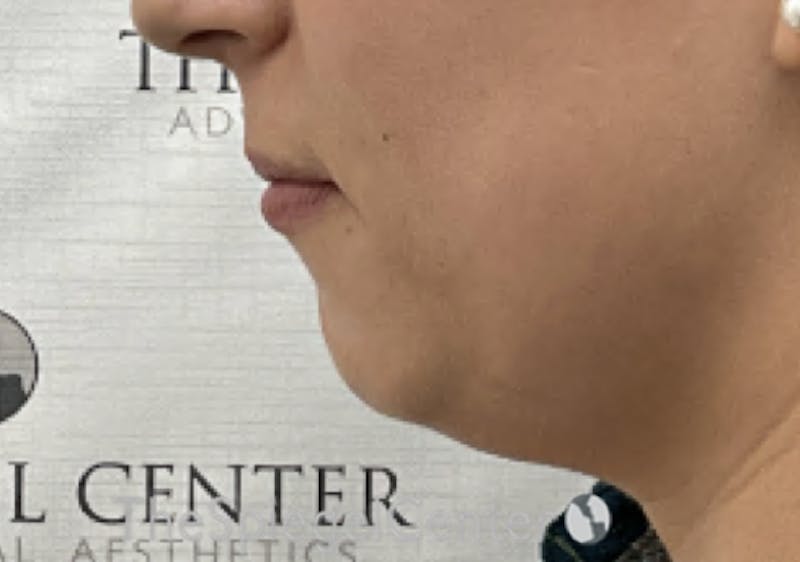 Chin Filler Before & After Gallery - Patient 326972 - Image 3