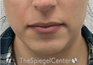 Chin Filler Before & After Gallery - Patient 326972 - Image 2