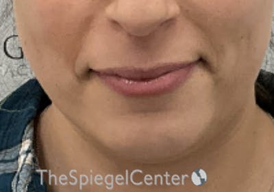 Chin Filler Before & After Gallery - Patient 326972 - Image 1