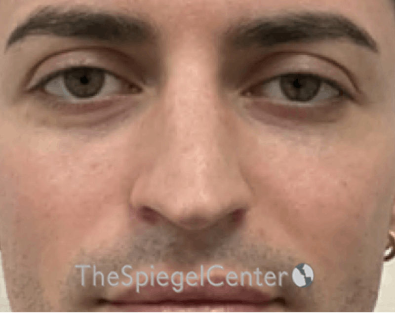 Rhinoplasty Before & After Gallery - Patient 233606 - Image 3