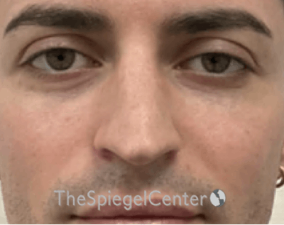 Rhinoplasty Before & After Gallery - Patient 233606 - Image 3