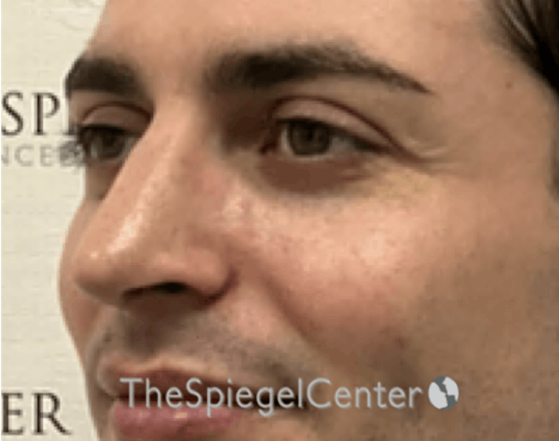 Rhinoplasty Before & After Gallery - Patient 233606 - Image 2
