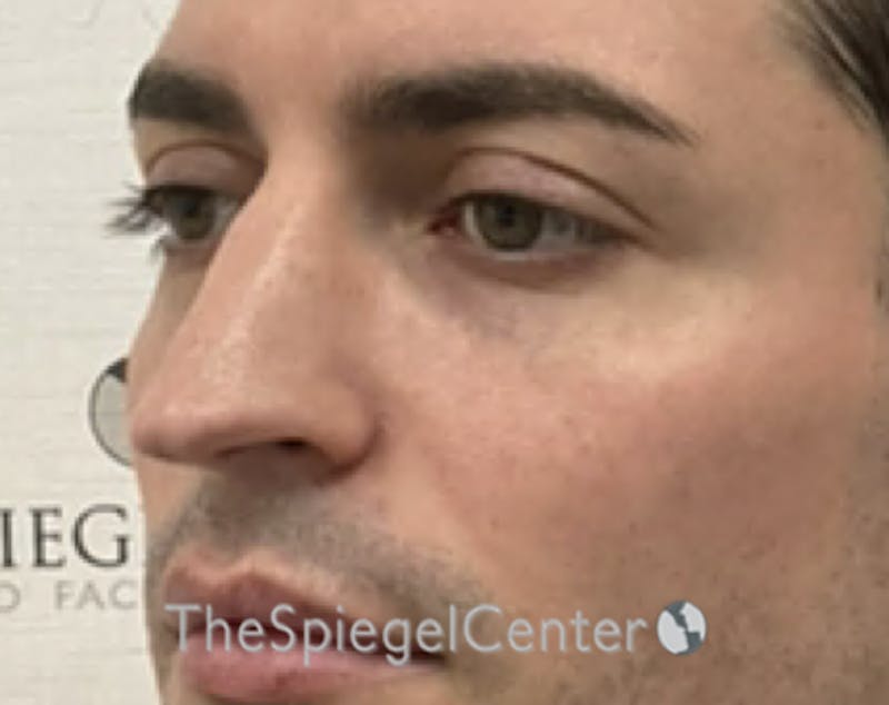 Rhinoplasty Before & After Gallery - Patient 233606 - Image 1