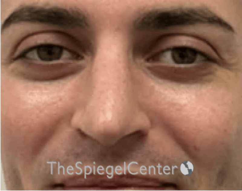 Rhinoplasty Before & After Gallery - Patient 233606 - Image 4