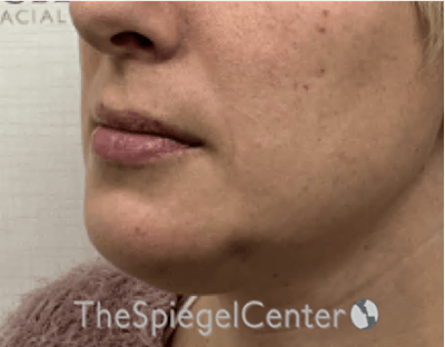 Chin Augmentation Before & After Gallery - Patient 246702 - Image 4